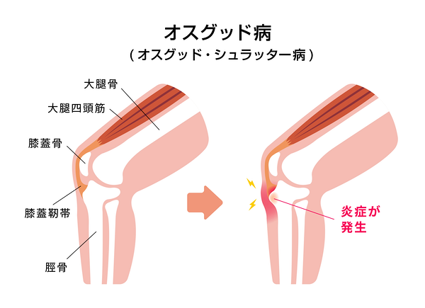 アキレス腱炎