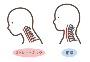 ストレートネック画像