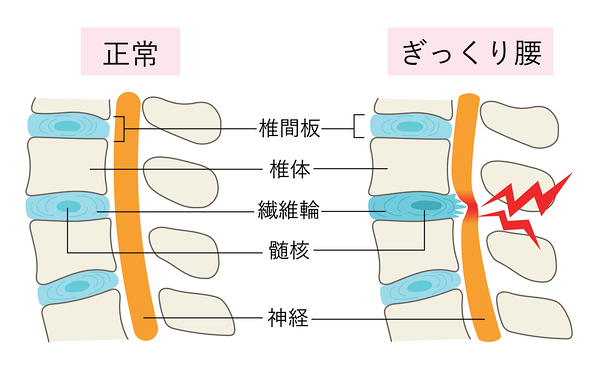 ぎっくり腰イラスト